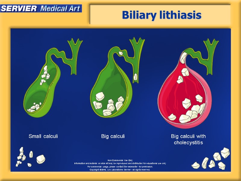 Biliary lithiasis Small calculi Big calculi with cholecystitis Big calculi
